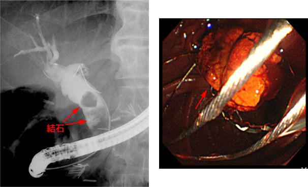 総胆管結石例に対する内視鏡的排石術