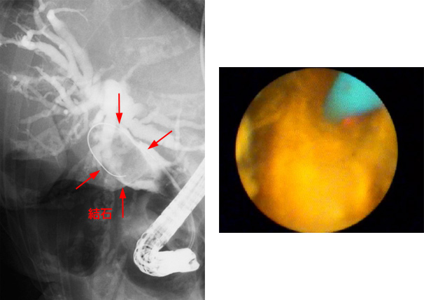 巨大結石例に対する経口胆道鏡下レーザー砕石術
