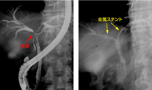 肝門部胆管癌における金属ステント複数本留置
