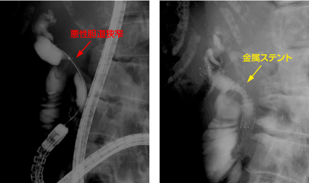 胃切除後再建腸管例におけるダブルバルーン小腸内視鏡を用いたERCP