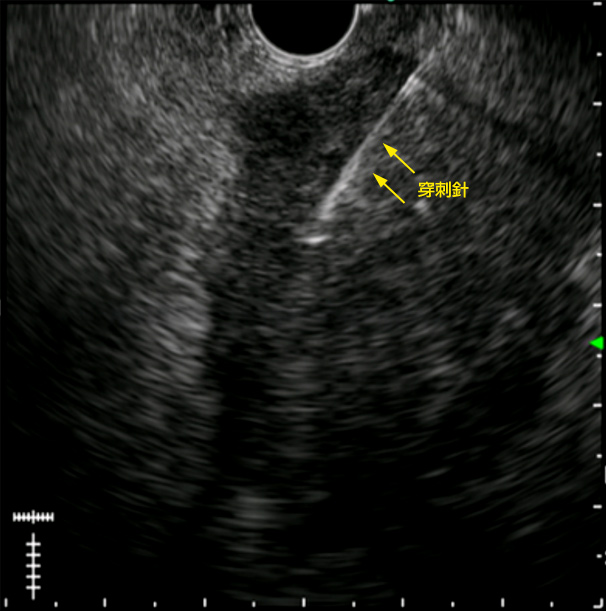 膵癌に対する超音波内視鏡下穿刺術（EUS-guided fine needle aspiration: EUS-FNA）