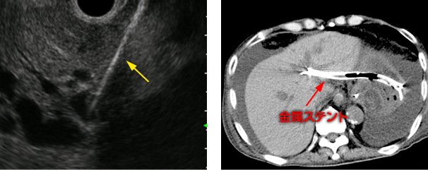 超音波内視鏡下肝内胆管胃吻合術 EUS-guided hepaticogastrostomy　(EUS-HGS)