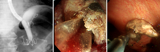 感染性被包化膵壊死(WON)に対する内視鏡的ネクロセクトミー