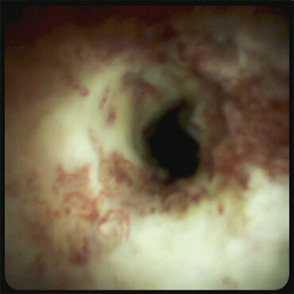 新型経口胆道/膵管鏡（Spyglass DS）による胆膵悪性疾患の診断